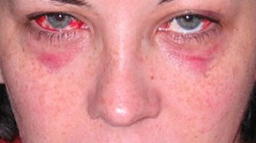Strangulation is one of the most lethal forms of domestic violence where unconsciousness may occur within seconds and death within minutes. In this course we will discuss the Violence Against Women Act (VAWA), domestic violence, national and state statistics, signs and symptoms of strangulation, and interviewing and investigating strangulation.
